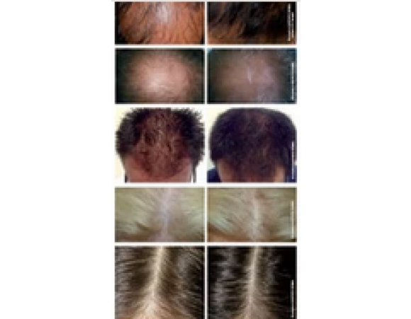 RRS XL Hair мезококтейль для стимуляции роста волос на основе гиалуроновой кислоты  5 мл img 3